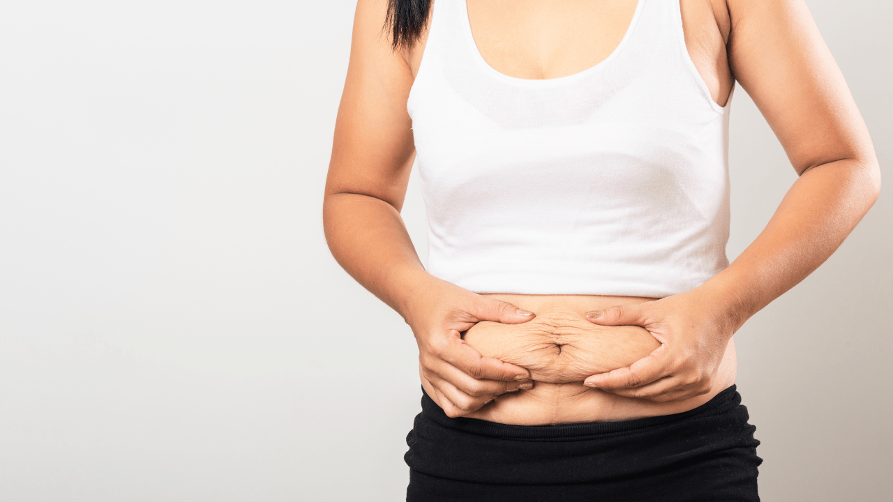 How to Prevent, Reduce or Tighten Loose Skin After Weight Loss